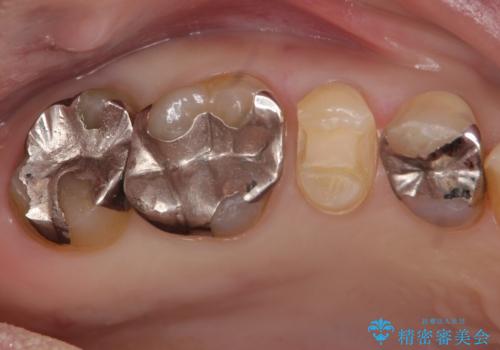歯が欠けた　金属による割れない修復の治療中