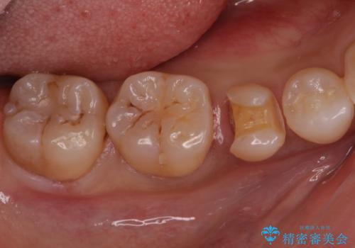 歯と歯の間の虫歯 セラミックインレーでの修復処置の治療中