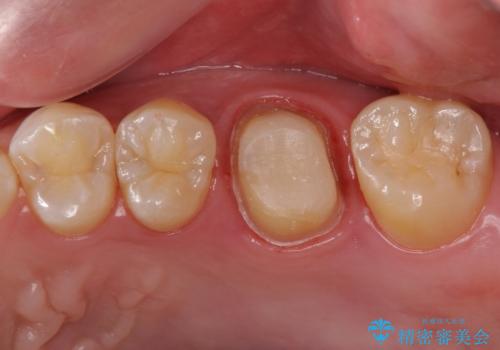不適合な被せ物 ジルコニアクラウンでの再治療の治療中