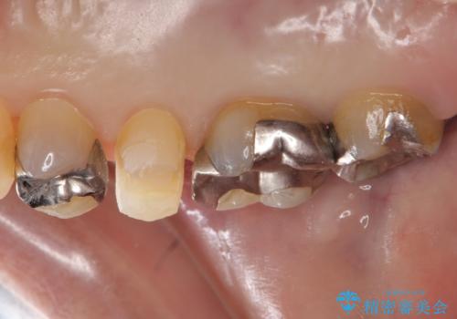 歯が欠けた　金属による割れない修復の治療中
