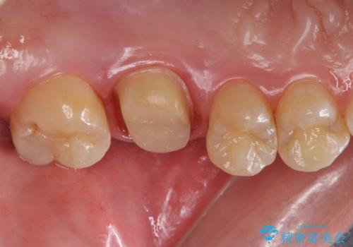 不適合な被せ物 ジルコニアクラウンでの再治療の治療中