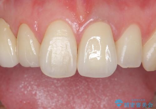 前歯を綺麗にしたい ジルコニアクラウンでの治療の治療後