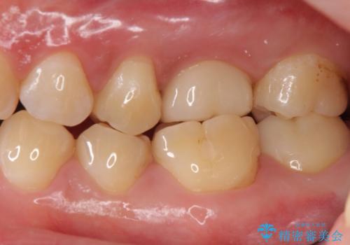 不適合な被せ物 ジルコニアクラウンでの再治療の治療後