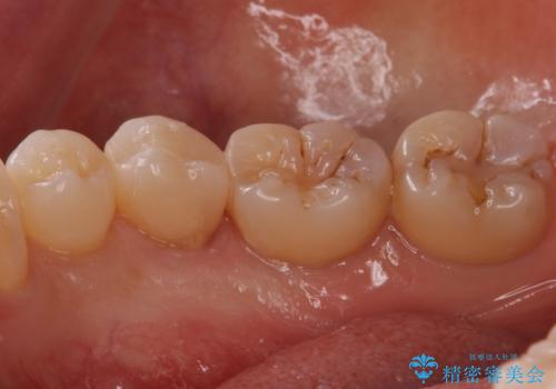 歯と歯の間の虫歯 セラミックインレーでの修復処置の治療後