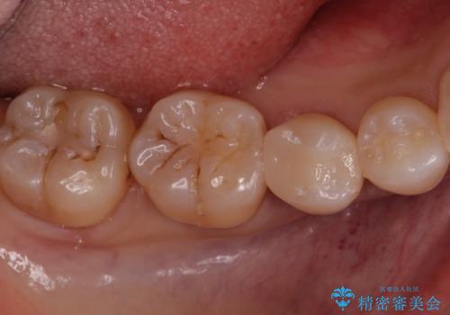 歯と歯の間の虫歯　セラミックインレーでの修復処置の治療後
