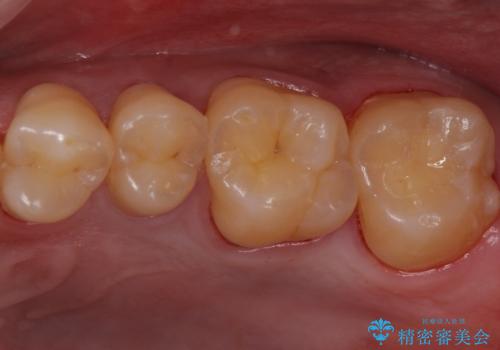 奥歯の虫歯 セラミックインレーでの修復処置の症例 治療後