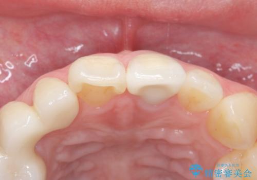 前歯を綺麗にしたい ジルコニアクラウンでの治療の治療後
