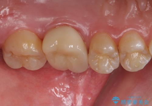 不適合な被せ物 ジルコニアクラウンでの再治療の治療後