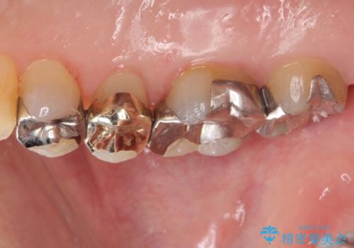 歯が欠けた　金属による割れない修復の治療後
