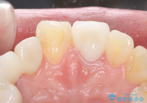 前歯を綺麗にしたい ジルコニアクラウンでの治療の治療後