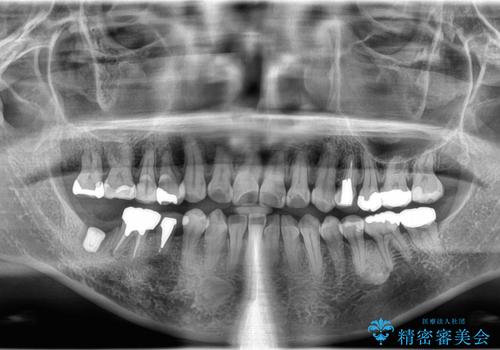 毎食後物がつまる! インプラント治療の治療後