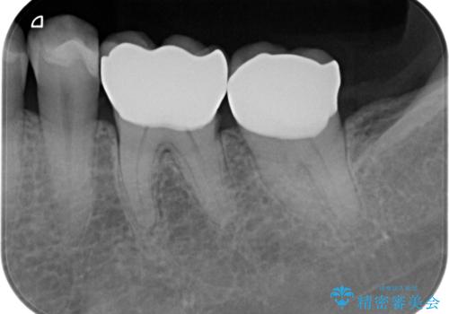 銀歯をセラミック治療で白くの治療後