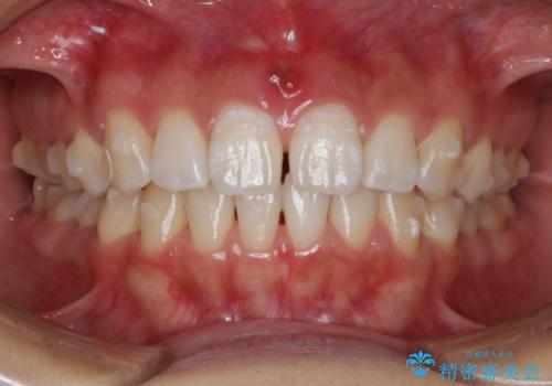 インビザライン矯正 前歯のすきっ歯を治したいの治療中