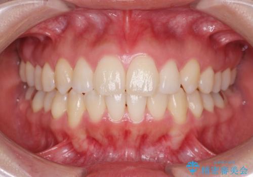 不安定な噛み合わせを改善 マウスピース矯正治療の治療後