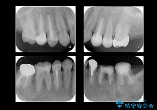 全体的な虫歯治療の治療前