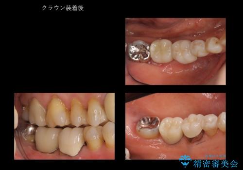 60代女性 奥歯のインプラント の治療後