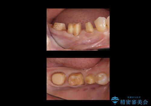 全体的な虫歯治療 他院で入れたインプラントの続きもの治療中