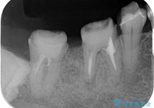 歯周病の歯を残すための再生治療の治療前