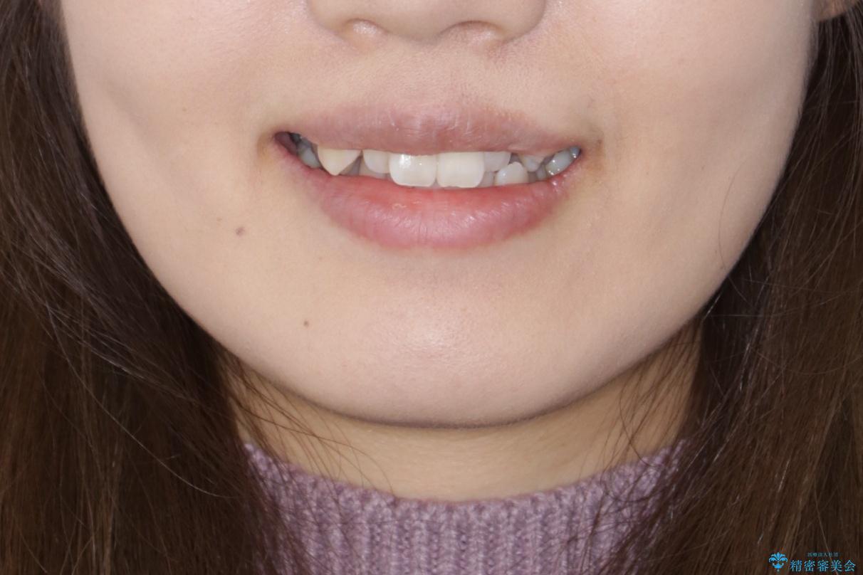 ワイヤー矯正　抜歯本数を最小限にし、八重歯のない歯並びに　の治療前（顔貌）