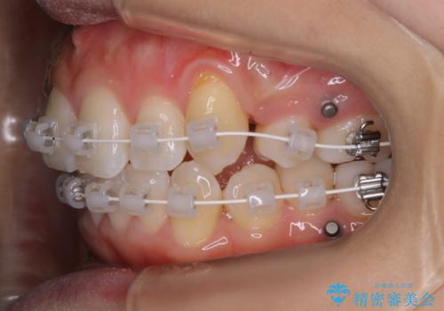 ワイヤー矯正　抜歯本数を最小限にし、八重歯のない歯並びに　の治療中