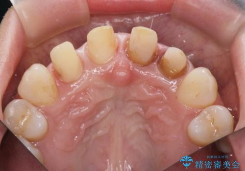 変色した歯を改善、セラミック治療の治療中