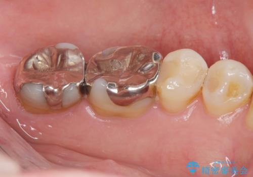 銀歯をセラミック治療で白くの治療前