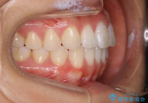 インビザライン矯正 前歯のすきっ歯を治したいの治療後