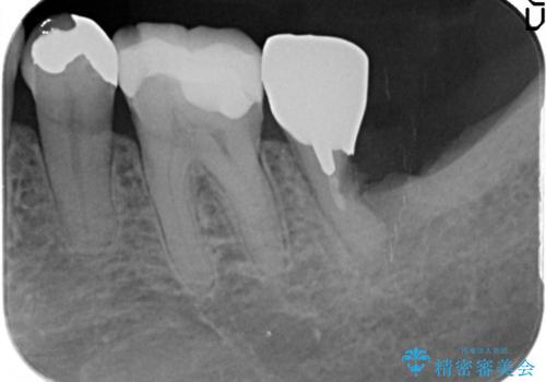 奥歯のインプラント 永くもつようにの治療前