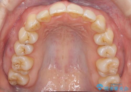 やや難ケース　上の歯を抜かずに歯列を後ろに下げて治療　4本ではなく下1本のみの抜歯できれいにの治療後