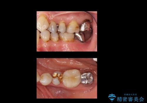 奥歯のインプラント 永くもつようにの治療前