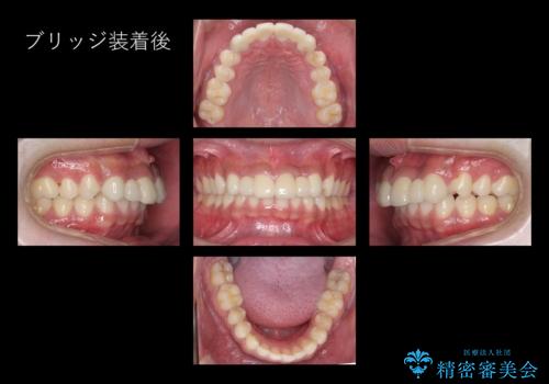 前歯のすきま 生まれつき歯が少ないのを治療の治療後