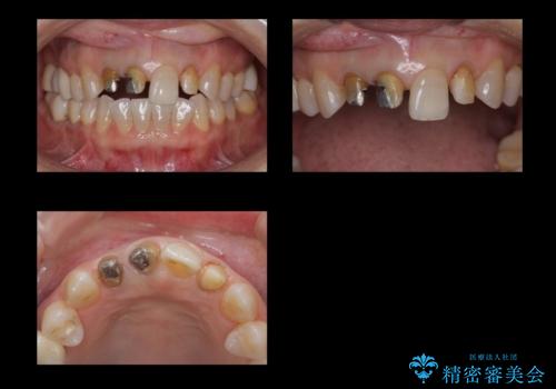 前歯のかぶせもののやり直し、根の治療もの治療中
