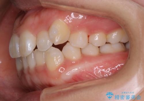 インビザライン矯正 短期間でがたつきのない歯並びに!の治療中