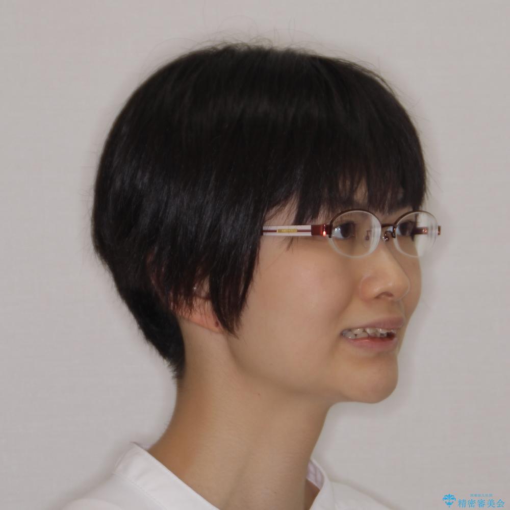 【モニター】出っ歯と八重歯 抜歯矯正でスッキリとした口元にの治療前(顔貌)