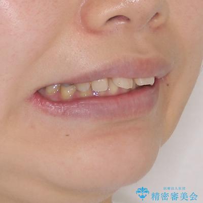 外科手術が必要と言えるほど突出した前歯　長期間をかけた抜歯矯正の治療前（顔貌）