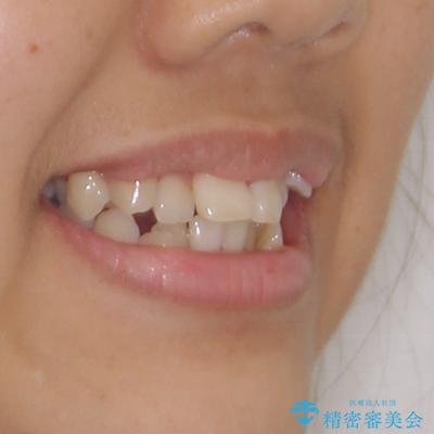 上顎骨幅が狭い　急速拡大装置を併用した抜歯矯正の治療前（顔貌）