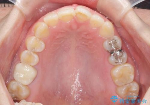 ねじれた前歯を改善するマウスピース矯正の治療後