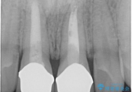 前歯の変色 神経のない歯の再治療の治療後