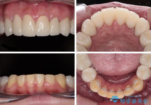 酸蝕歯でボロボロの歯の審美歯科治療　矯正治療も併用して、美しい口元への治療後