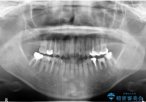 全体的な虫歯治療の治療前