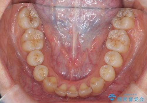 やや難ケース 上の歯を抜かずに歯列を後ろに下げて治療 4本ではなく下1本のみの抜歯できれいにの治療後