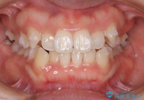 インビザライン矯正 短期間でがたつきのない歯並びに!の治療中