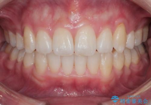 ワイヤー矯正　抜歯本数を最小限にし、八重歯のない歯並びに　の症例 治療後