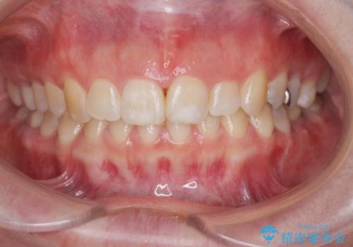 ねじれた前歯を改善するマウスピース矯正の症例 治療後