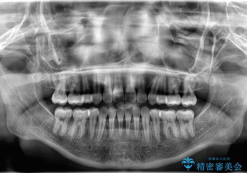 【埋伏歯】犬歯の牽引を行った矯正歯科治療の治療後