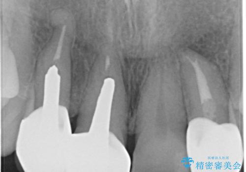 前歯のかぶせもののやり直し、根の治療もの治療後