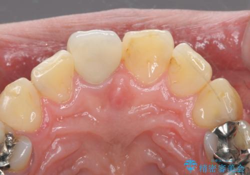 折れてしまった前歯   オールセラミックによる審美改善の治療後