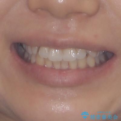 気になる八重歯 ワイヤー装置での非抜歯矯正の治療前(顔貌)
