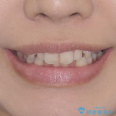 痛むむし歯と小さい歯とデコボコ むし歯治療と矯正治療を並行した総合歯科治療の治療前(顔貌)