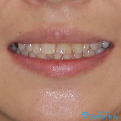 ハーフリンガルで歯列をきれいに セラミック治療で気になる銀歯も自然な色にの治療前(顔貌)